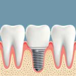 Dental Implants Milford OH